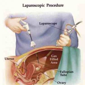laparoscopy